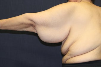 Arm Lift (Brachioplasty)
