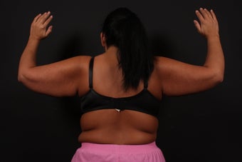 Arm Lift