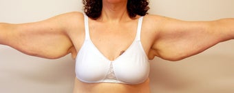 Brachioplasty