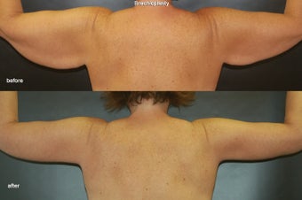 Brachioplasty