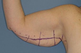 Arm Lift
