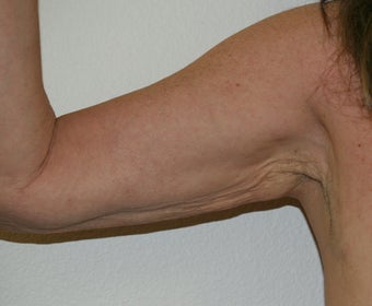 Arm lift (brachioplasty)