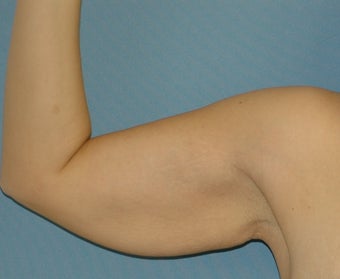 Brachioplasty