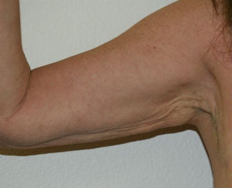 Arm lift