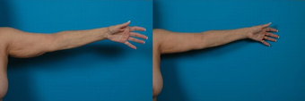 Arm Lift