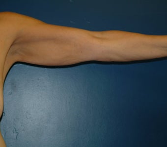 Brachioplasty