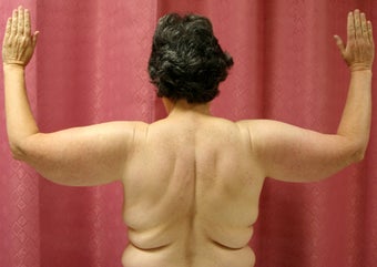 Brachioplasty or arm tuck in los angeles