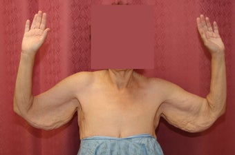 Brachioplasty or arm tuck in los angeles