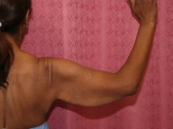 Brachioplasty or arm tuck
