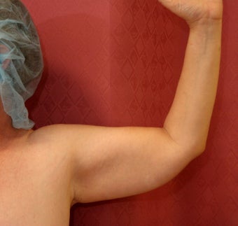 Brachioplasty or arm tuck
