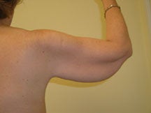 Arm Lift