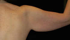 Arm Lift