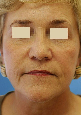 Artefill for NasoLabial Folds