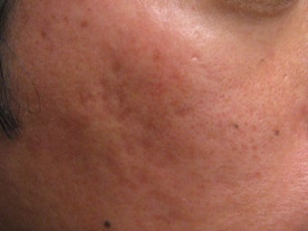 Artefill treatment of Acne Scars
