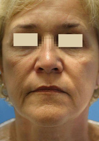 Artefill for NasoLabial Folds