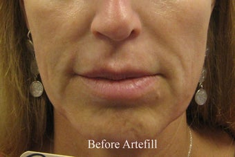 Artefill 