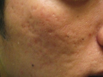 Artefill treatment of Acne Scars
