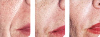 Aftefill injection before and after
