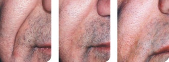 Artefill for nasolabial fold repair
