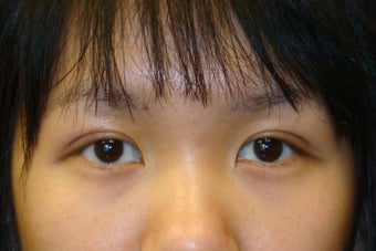 Double lid Asian blepharoplasty
