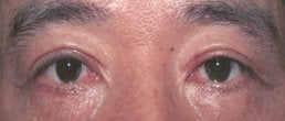 Eyelid Surgery