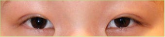 Asian Double Eyelid Surgery - Asian Blepharoplasty