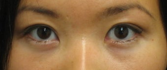 Double eyelid surgery with CO2 laser