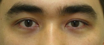 Asian blepharoplasty