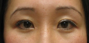 Upper and lower blepharoplasty by CO2 laser