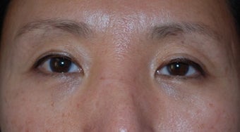Asian Blepharoplasty to remove eye bags