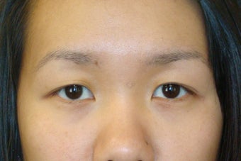 Double lid Asian blepharoplasty
