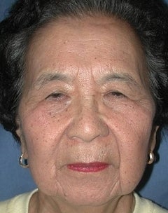 Lateral Browlift & Upper Lid Blepharoplasty