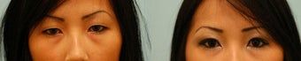 Asian Blepharoplasty ("Double Eyelid" Procedure)