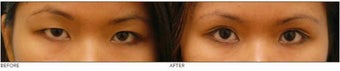 Asian Blepharoplasty ("Double Eyelid" Procedure)