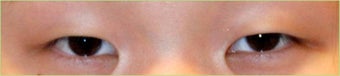 Asian Double Eyelid Surgery - Asian Blepharoplasty