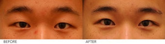 Asian Blepharoplasty