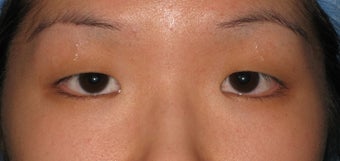 Double eyelid surgery by CO2 laser