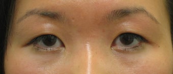 Double eyelid surgery with CO2 laser