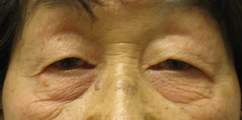 Upper and lower blepharoplasty by laser