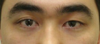 Asian blepharoplasty