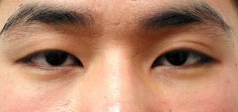 Asian blepharoplasty by incisional technique