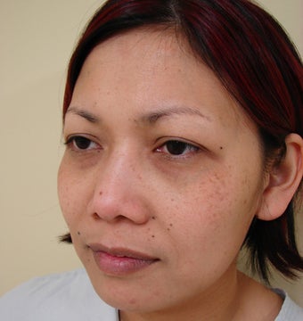 Upper eye lid surgery