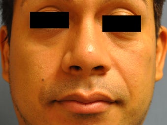 Rhinoplasty