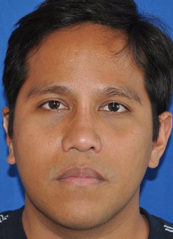 Rhinoplasty-Asian