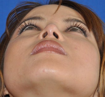 Rhinoplasty-Nostril shaping