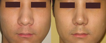 Rhinoplasty