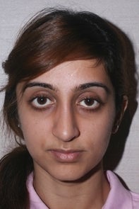 Asian Rhinoplasty