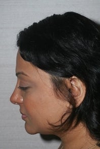 Asian Rhinplasty
