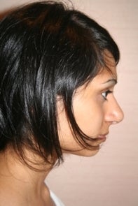 Asian Rhinoplasty