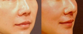 Asian rhinoplasty